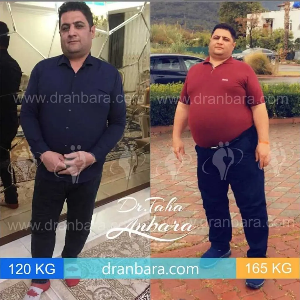 عمل اسلیو؛ جدیدترین عمل لاغری در دنیا + تجربه کسانی که عمل اسلیو انجام داده اند 2