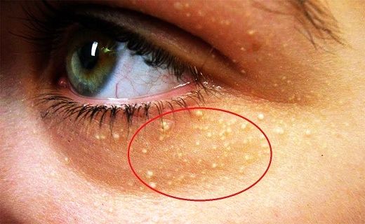 چشم‌ها ابتلا به این بیماری خطرناک را نشان می‌دهند