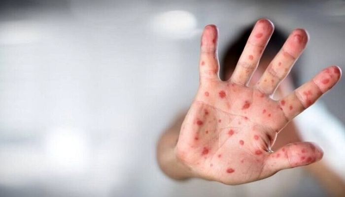 آخرین وضعیت آبله میمونی در کشور/ آبله میمون در اروپا ریشه کن شد؟

